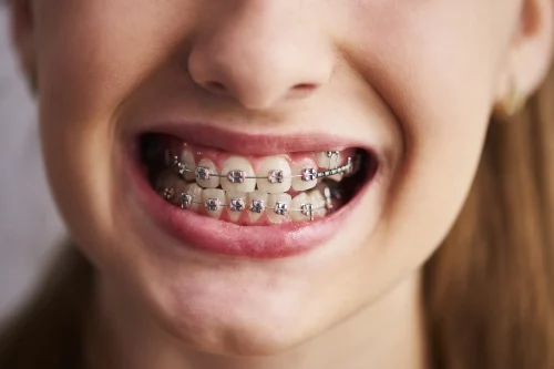 IMED German Clinic - Aparato dental