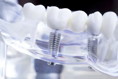 IMED German Clinic - Microimplantes