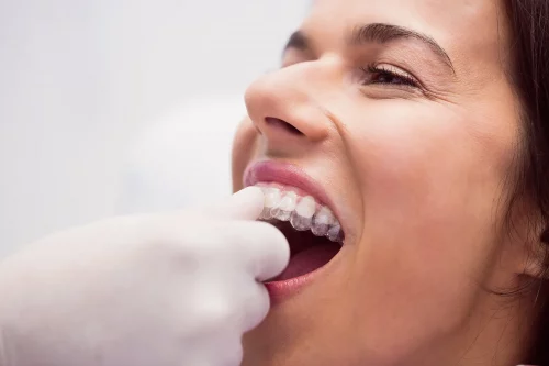 IMED German Clinic - Invisalign in Marbella
