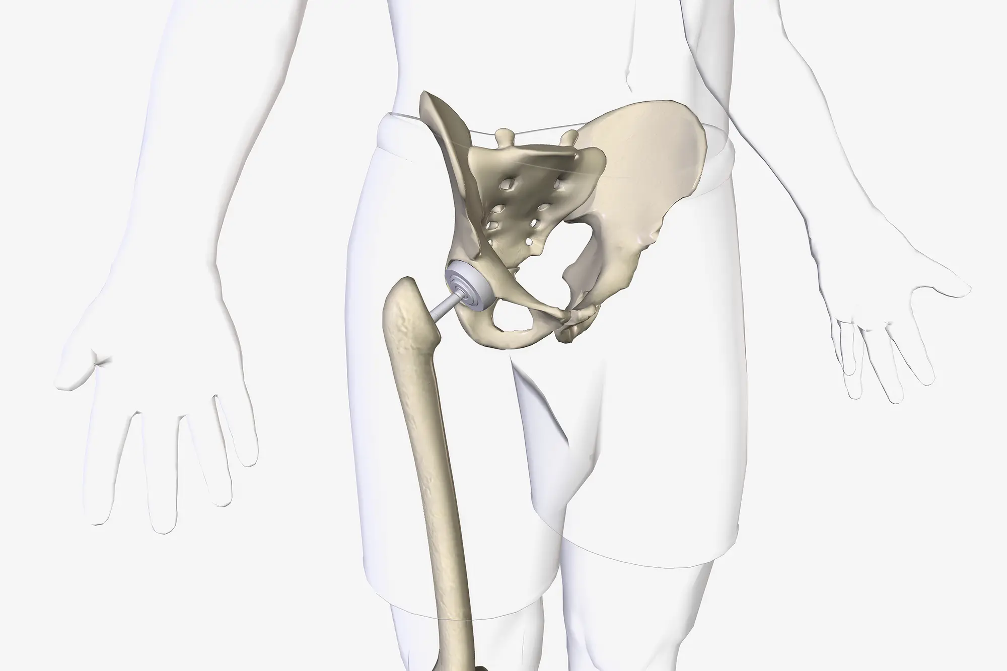 IMED German Clinic - Reemplazo de cadera en Marbella