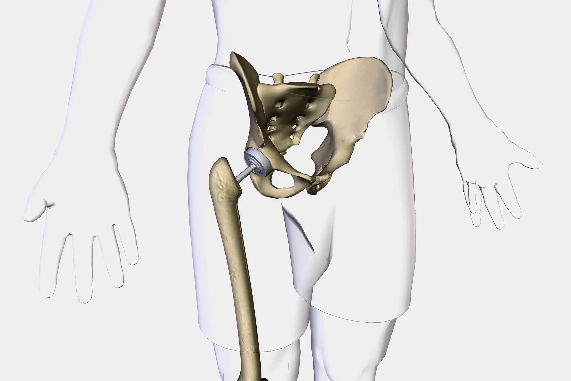 artroplastia de cadera